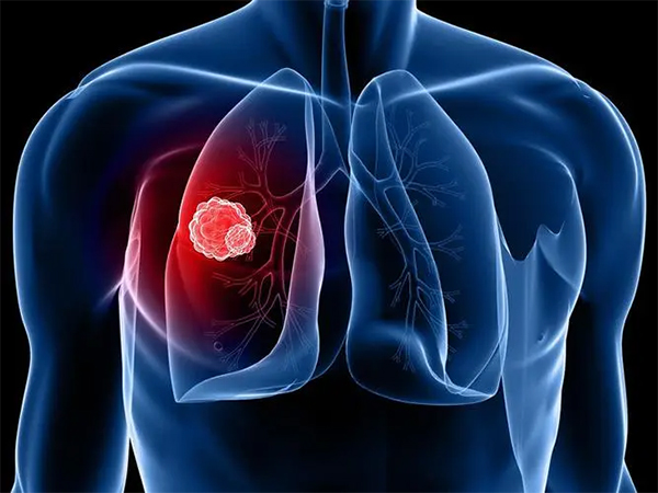 肺结节是否会发展成肺瘤？会出现哪些症状？中医如何预防？
