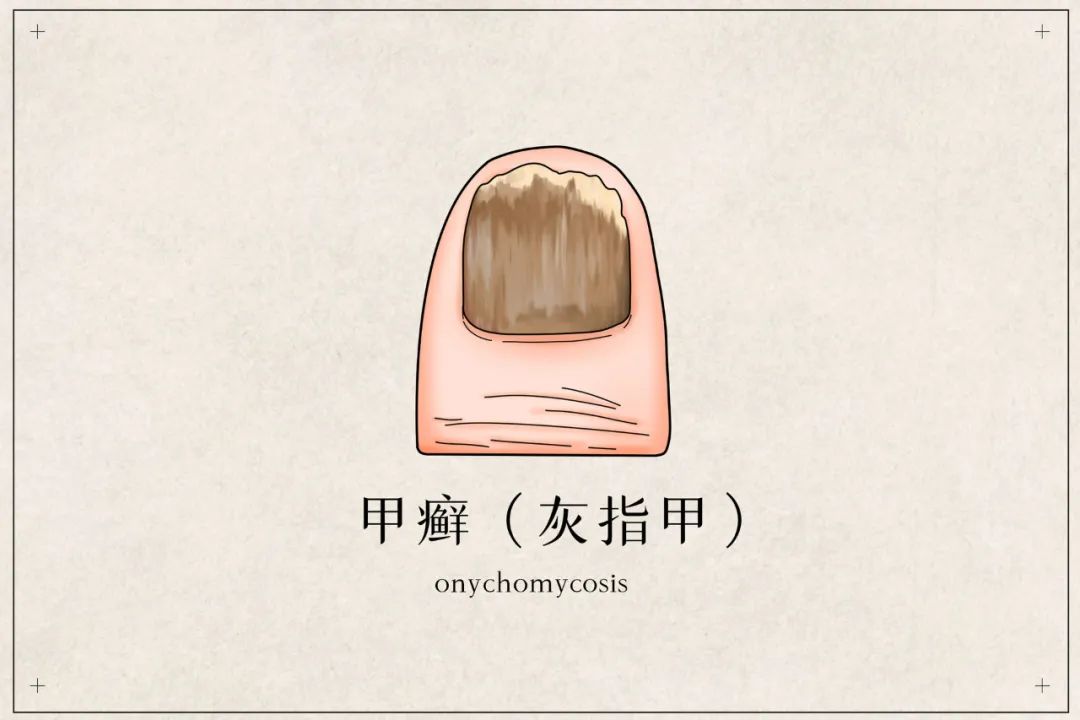 灰指甲.jpg