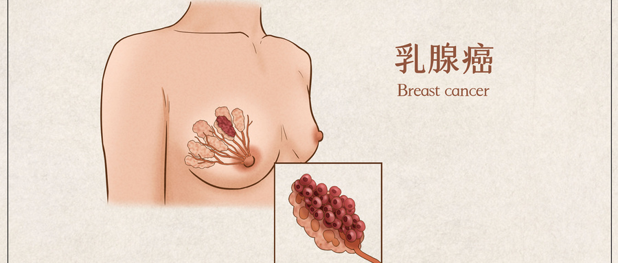 摄图网_401789478_wx_乳腺癌医疗插画示意图(企业商用).jpg